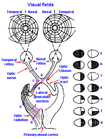 Visual Field Deficits